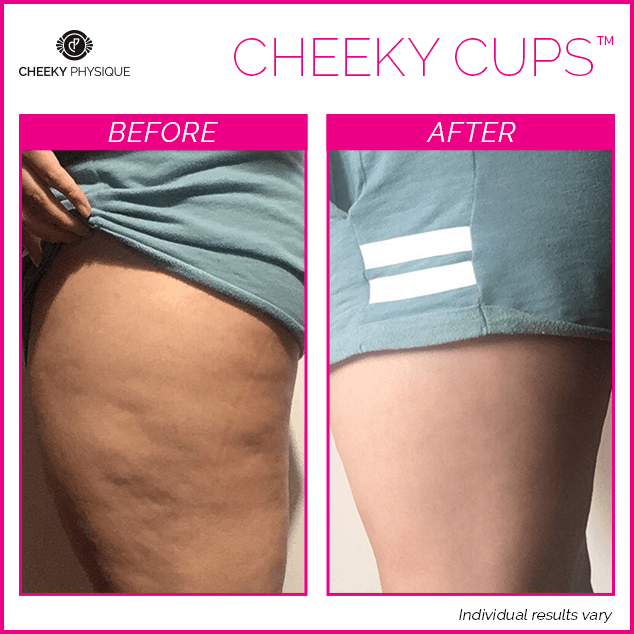 Before and After - Cheeky Cups Body Contouring Kit