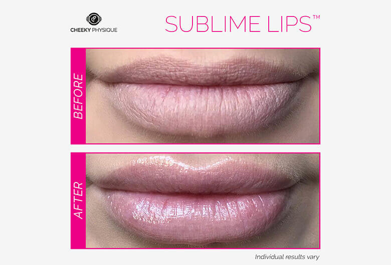 Sublime Lips Before And After