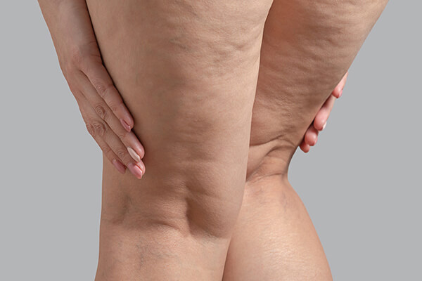 woman's legs with cellulites