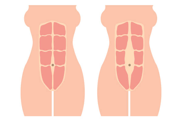 diastasis recti diagram