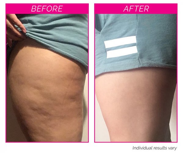 Bye Bye Cellulite Kit before and after